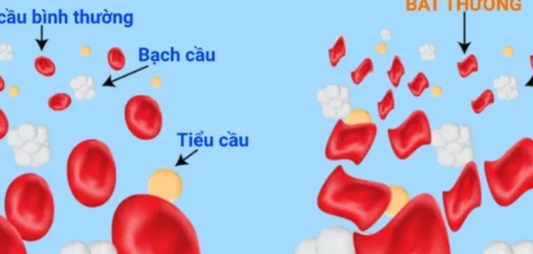 Bệnh tan máu bẩm sinh Thalassemia